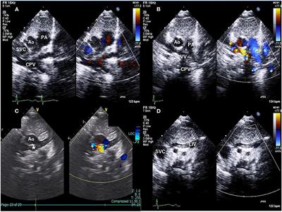 Case Report: Retroaortic Innominate Vein With Supracardiac Total Anomalous Pulmonary Venous Connection